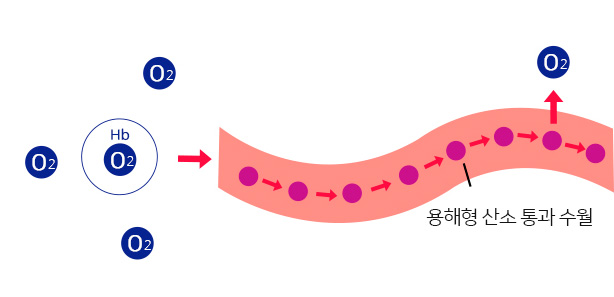 고압산소테라피